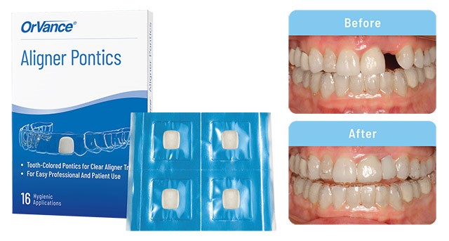 Aligner Pontics Solution For End Patient Image