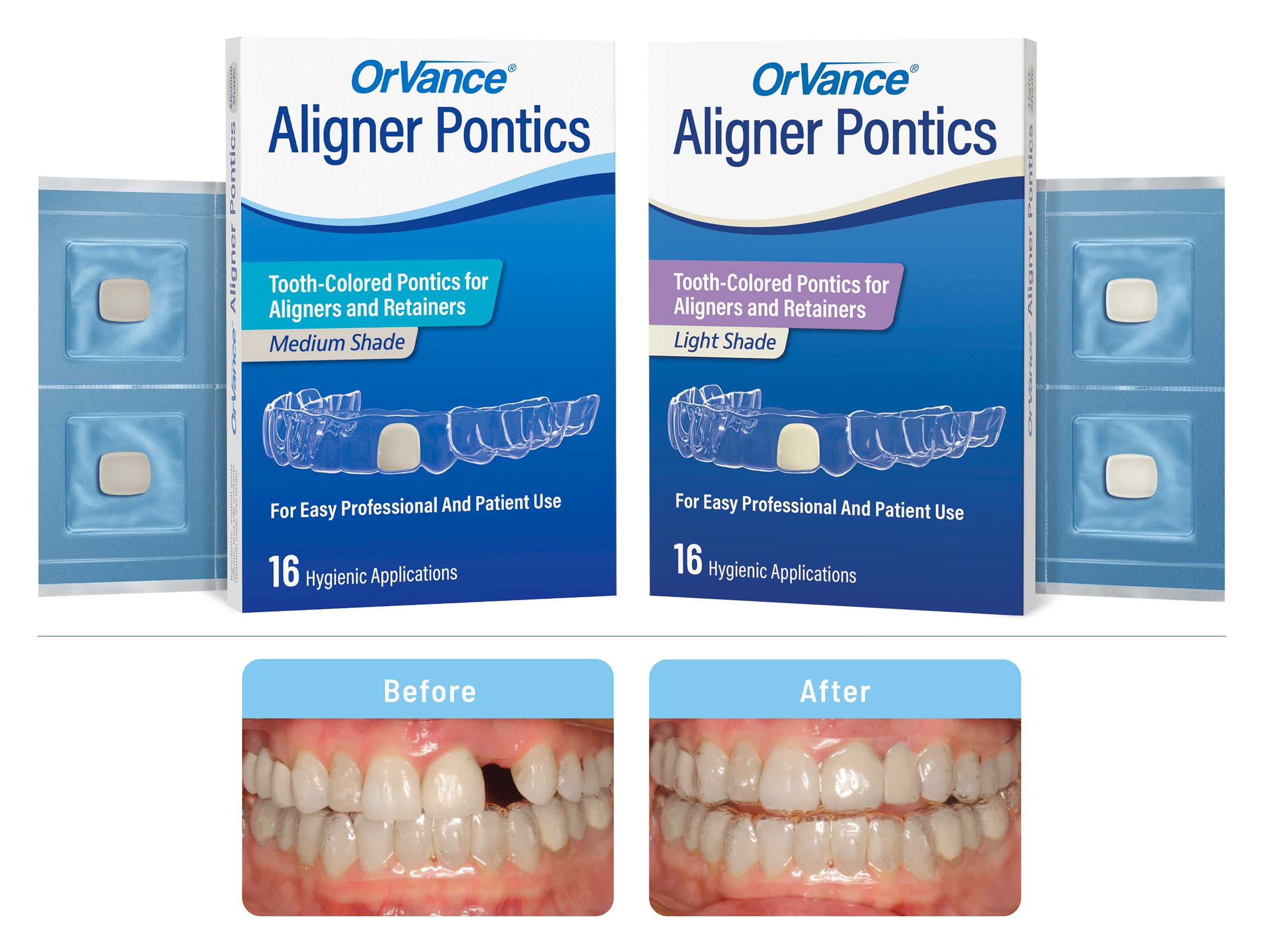 OrVance® Aligner Pontics for Practices