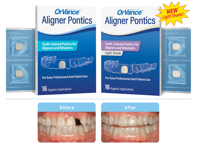 OrVance® Aligner Pontics for Practices