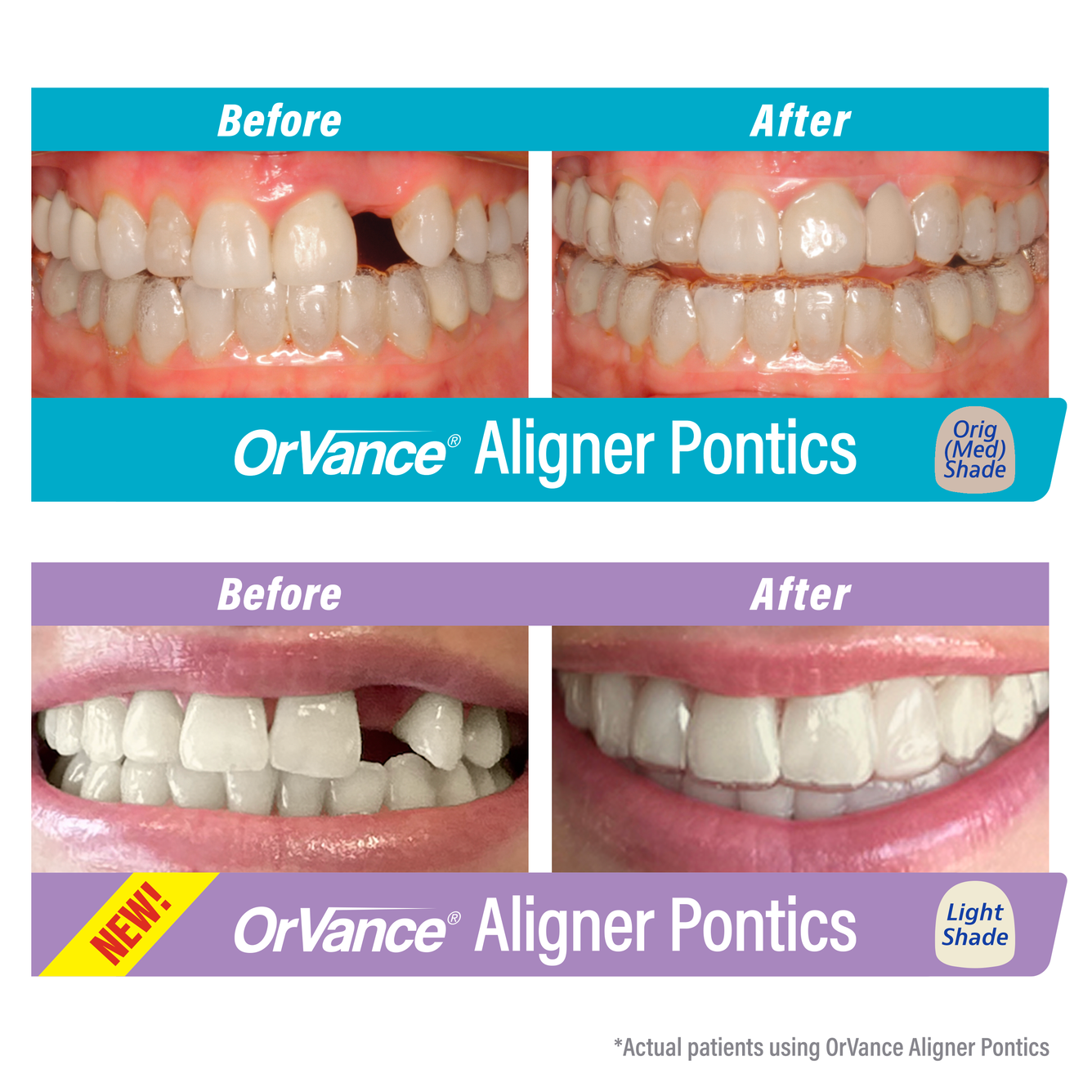 OrVance® Aligner Pontics for Practices